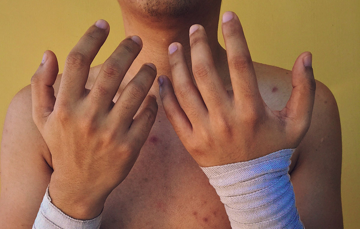 Complications if Left Untreated