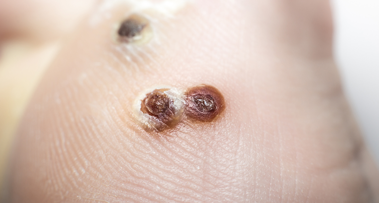 Understanding HPV and the Importance of Vaccination