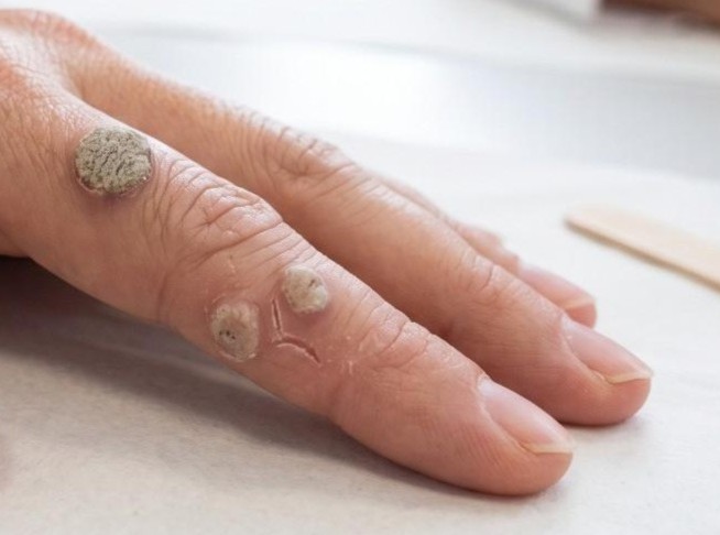 Type of Warts